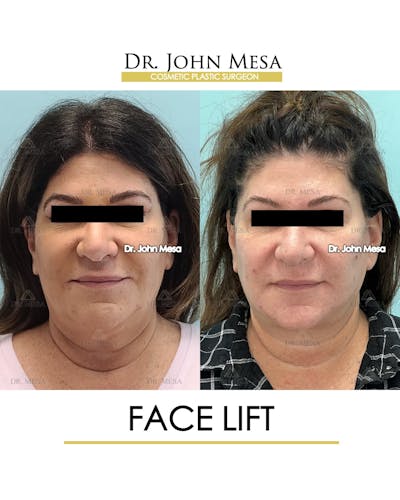 Facelift Before & After Gallery - Patient 852069 - Image 1