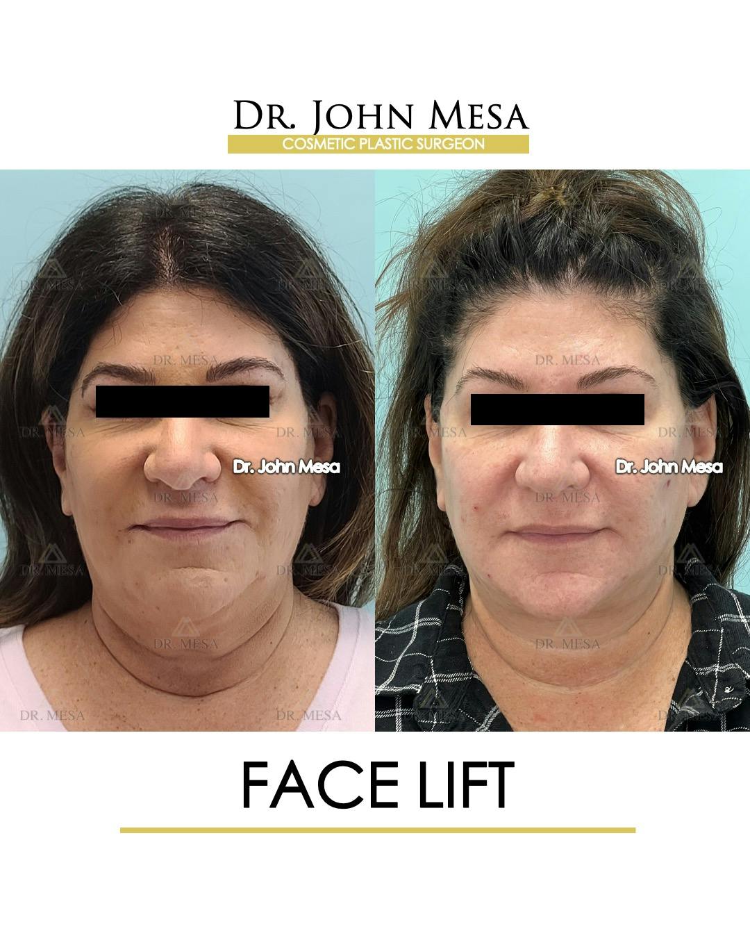 Facelift Before & After Gallery - Patient 852069 - Image 1
