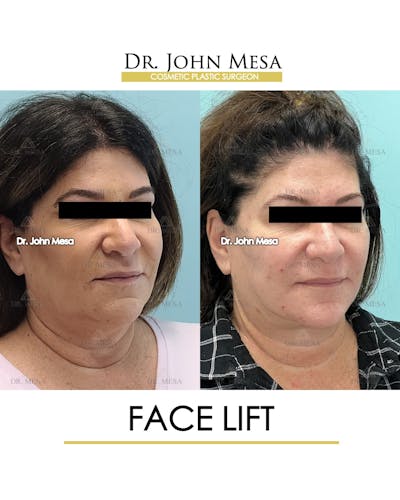 Facelift Before & After Gallery - Patient 852069 - Image 2