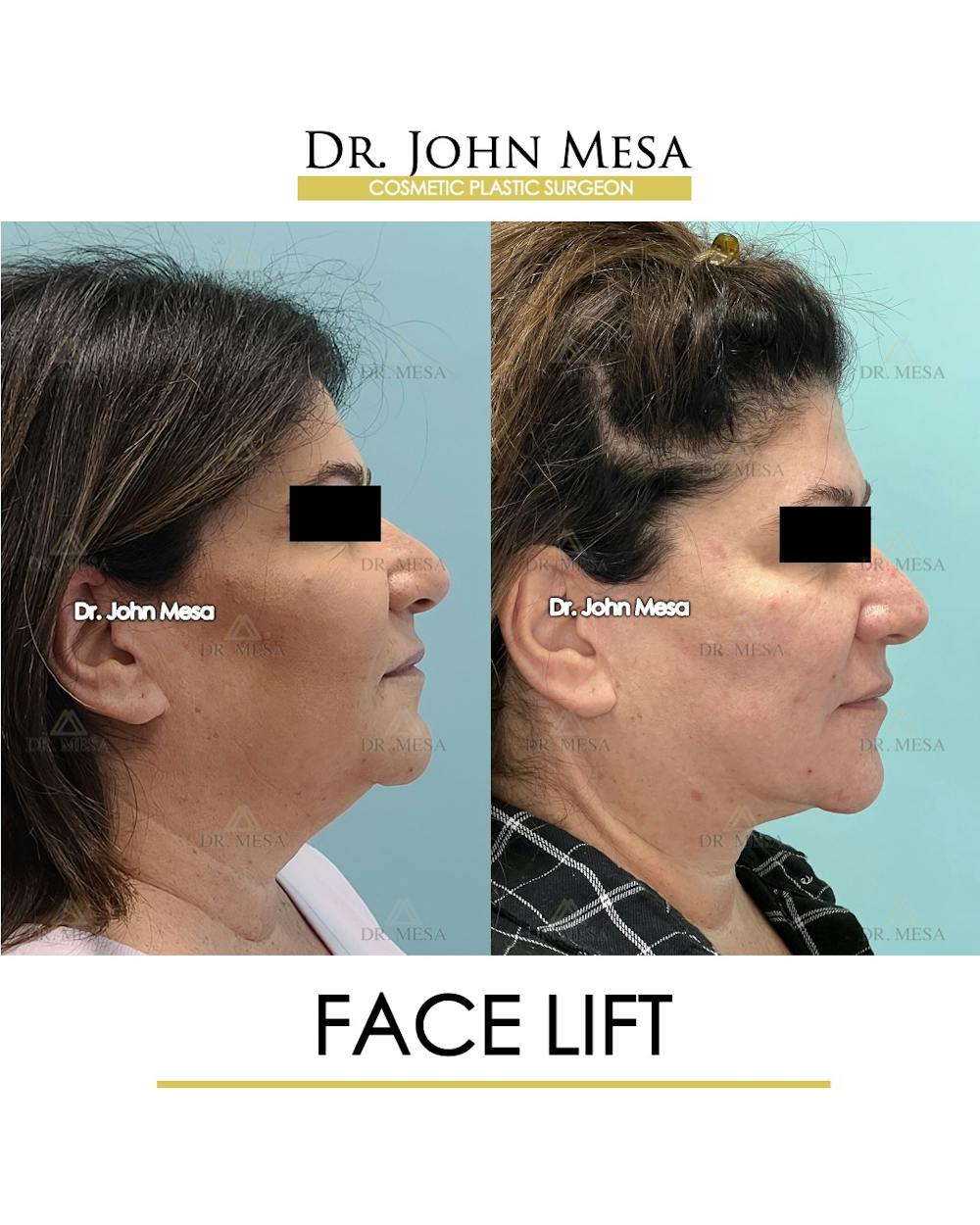 Facelift Before & After Gallery - Patient 852069 - Image 3