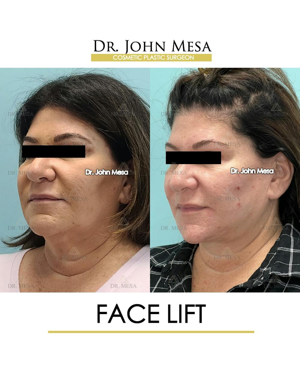 Facelift Before & After Gallery - Patient 852069 - Image 4