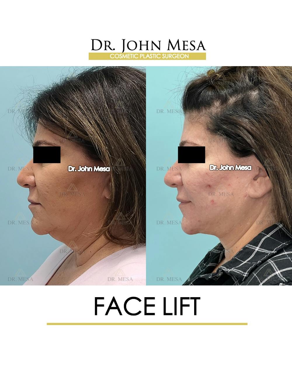 Facelift Before & After Gallery - Patient 852069 - Image 5