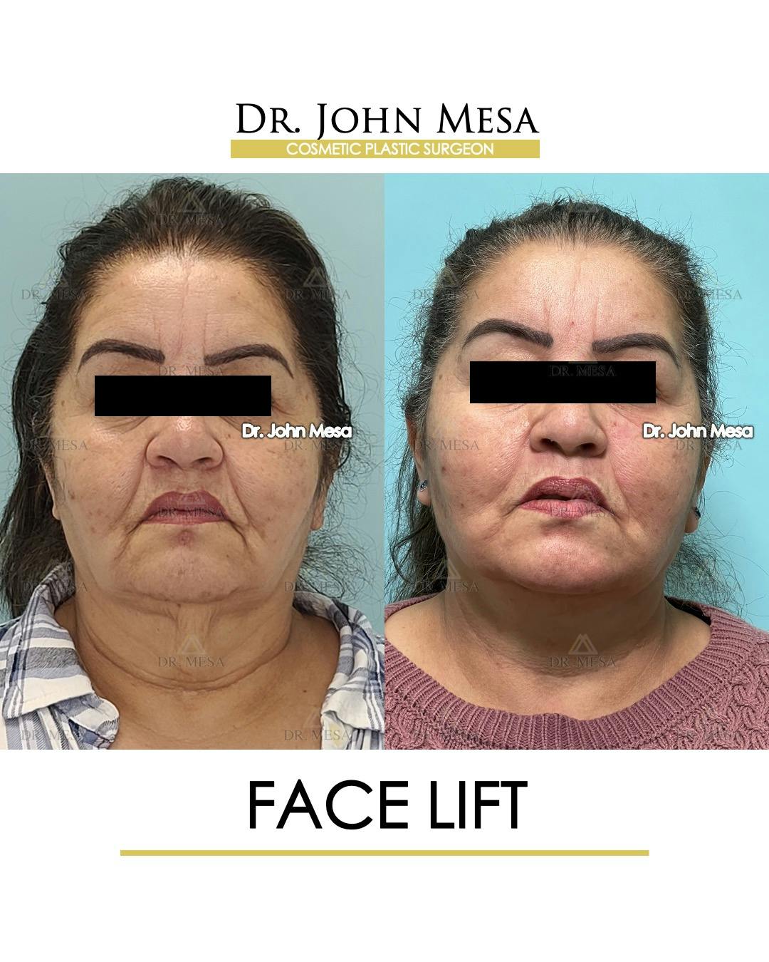Facelift Before & After Gallery - Patient 376160 - Image 1