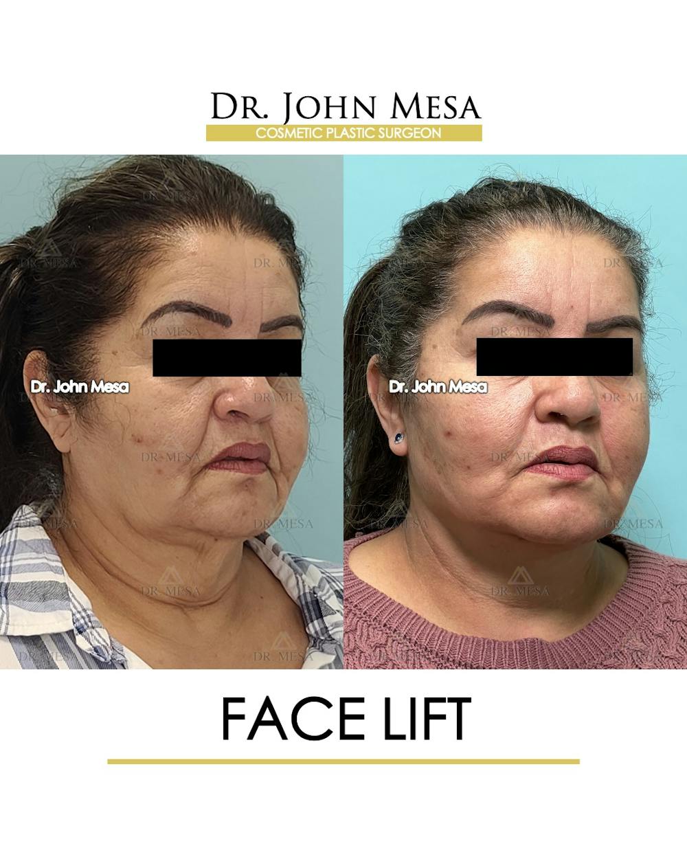 Facelift Before & After Gallery - Patient 376160 - Image 2