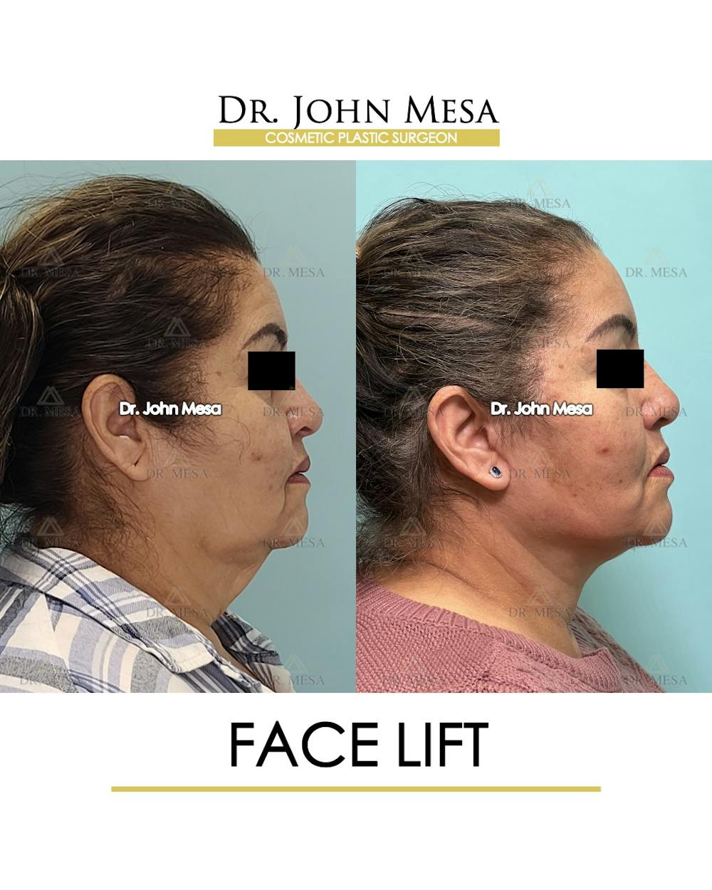 Facelift Before & After Gallery - Patient 376160 - Image 3