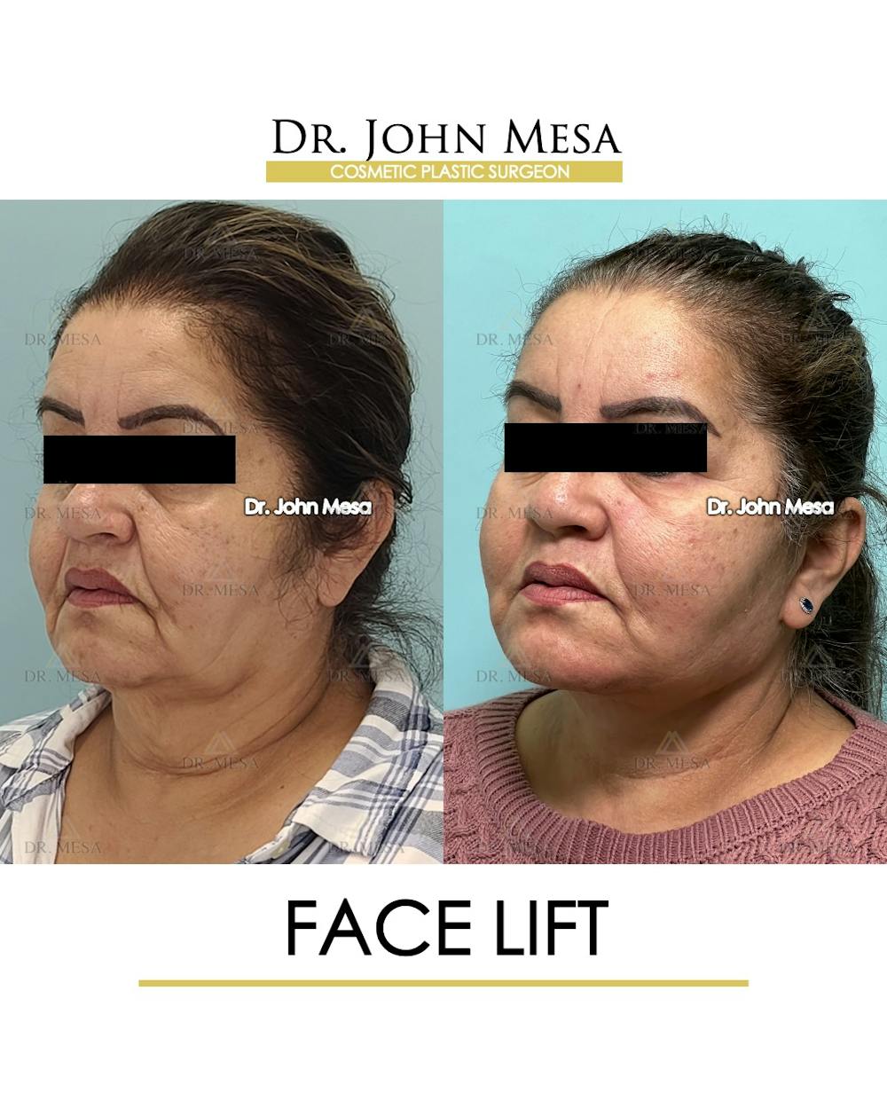 Facelift Before & After Gallery - Patient 376160 - Image 4