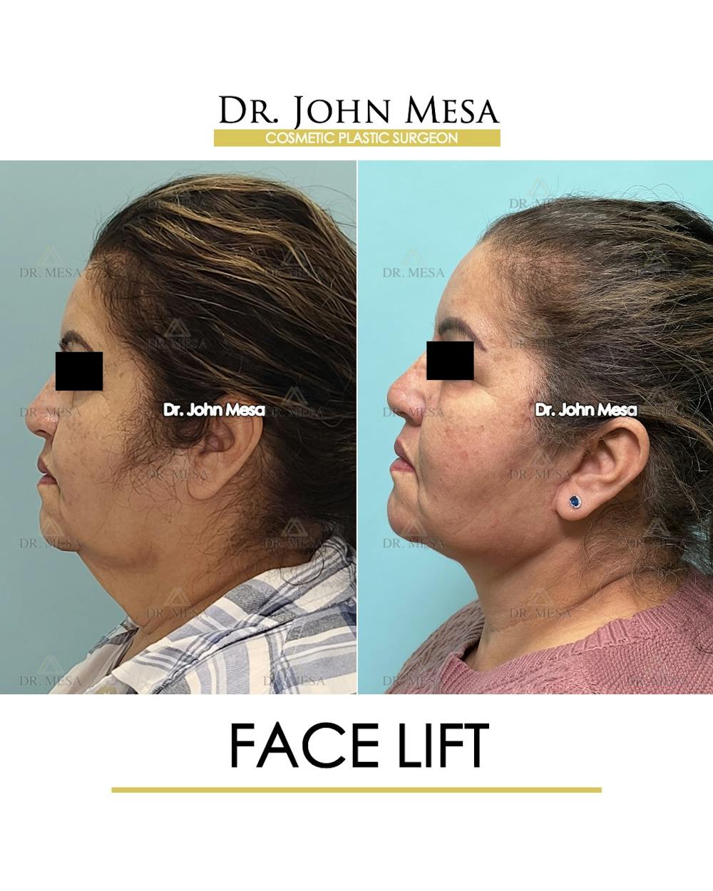 Facelift Before & After Gallery - Patient 376160 - Image 5