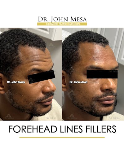Forehead Lines Filler Before & After Gallery - Patient 282081 - Image 2