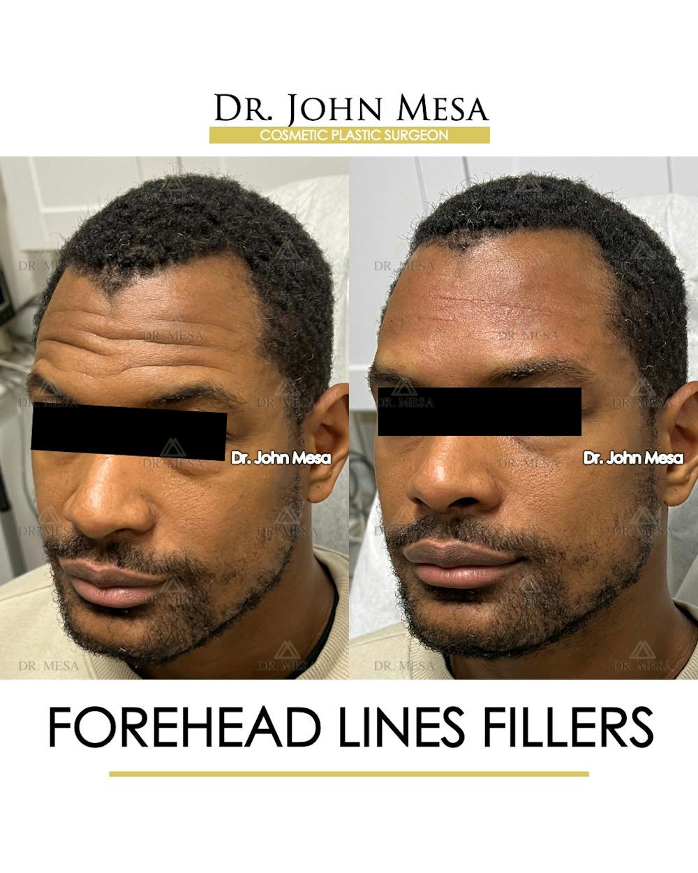 Forehead Lines Filler Before & After Gallery - Patient 282081 - Image 3