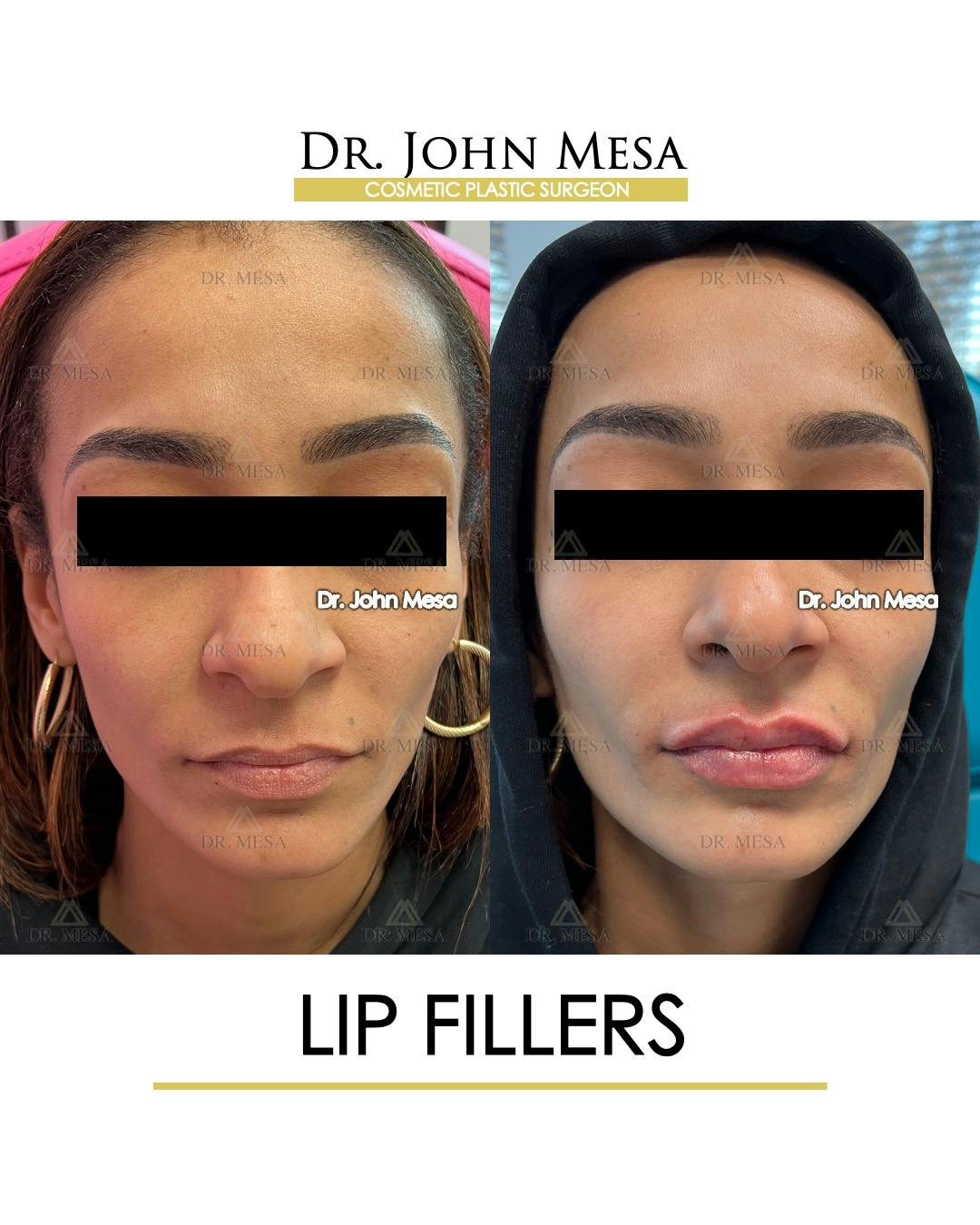 Lip Augmentation (Injectables) Before & After Gallery - Patient 216505 - Image 1
