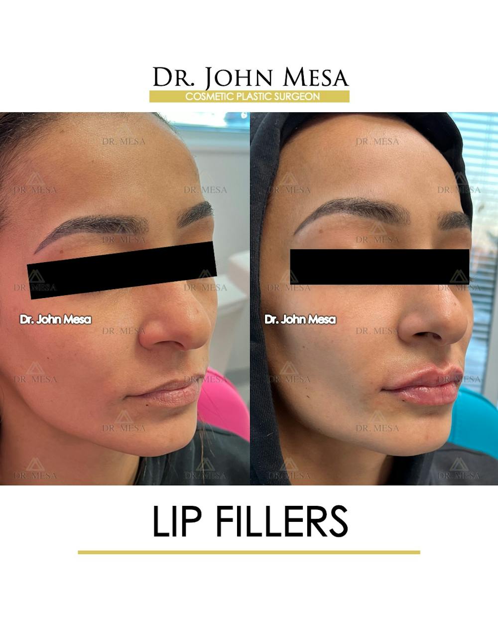 Lip Augmentation (Injectables) Before & After Gallery - Patient 216505 - Image 2