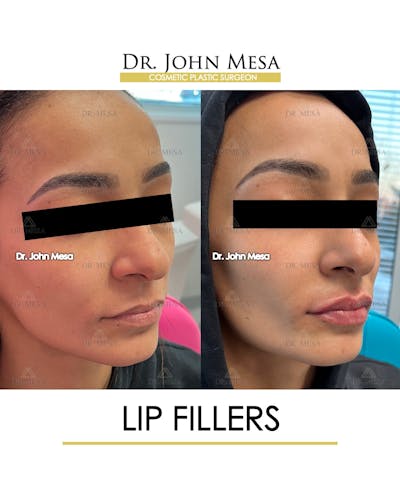 Lip Augmentation (Injectables) Before & After Gallery - Patient 216505 - Image 2