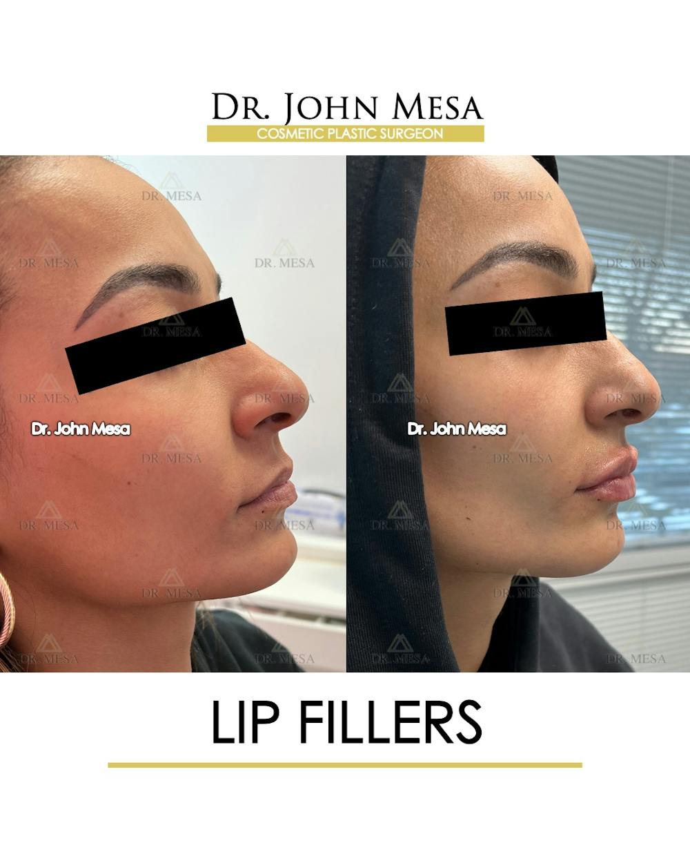 Lip Augmentation (Injectables) Before & After Gallery - Patient 216505 - Image 3