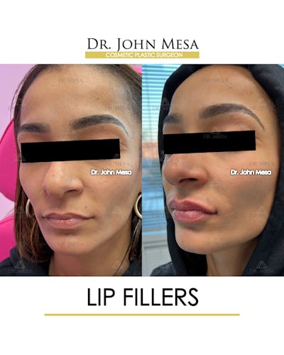 Lip Augmentation (Injectables) Before & After Gallery - Patient 216505 - Image 4