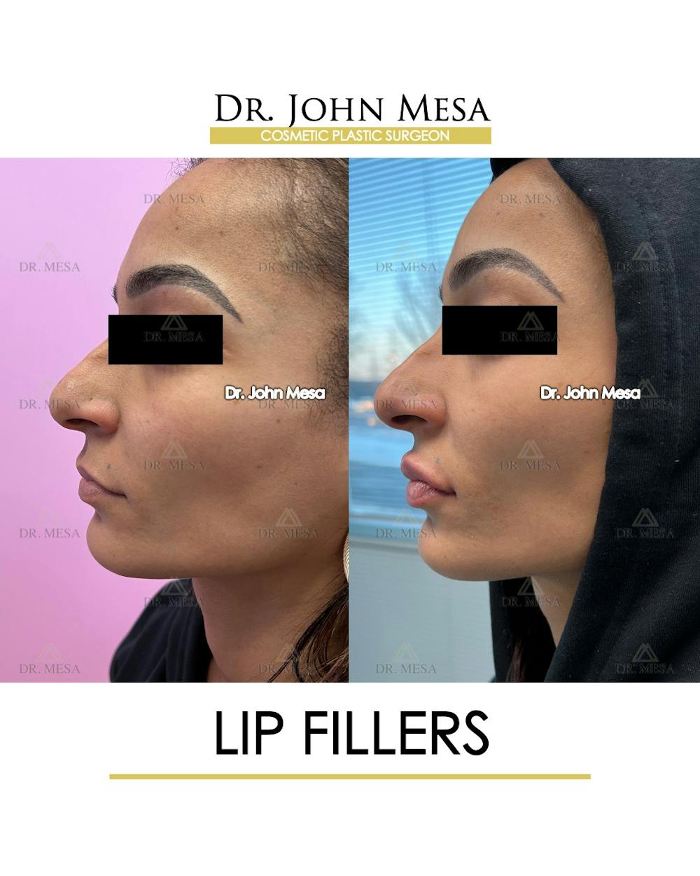 Lip Augmentation (Injectables) Before & After Gallery - Patient 216505 - Image 5