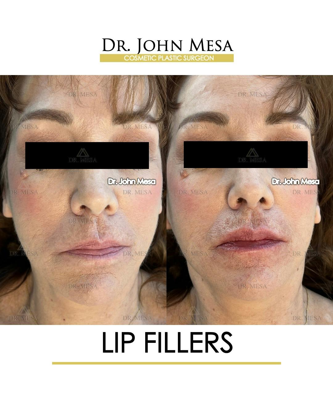 Lip Augmentation (Injectables) Before & After Gallery - Patient 309244 - Image 1