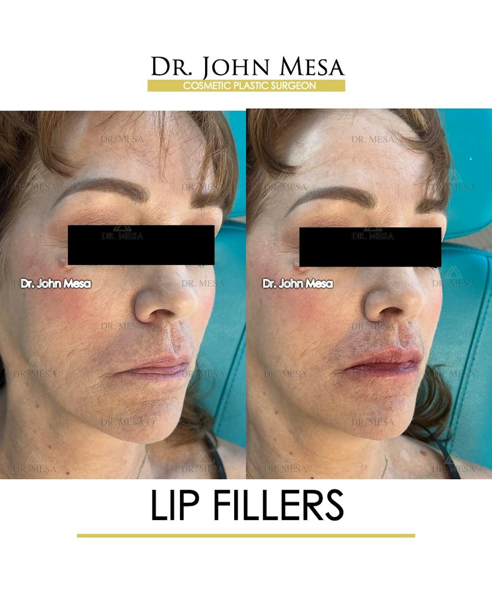 Lip Augmentation (Injectables) Before & After Gallery - Patient 309244 - Image 2
