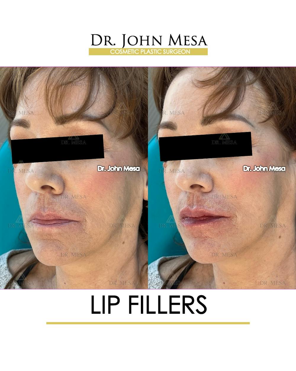 Lip Augmentation (Injectables) Before & After Gallery - Patient 309244 - Image 3