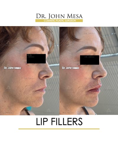 Lip Augmentation (Injectables) Before & After Gallery - Patient 309244 - Image 4