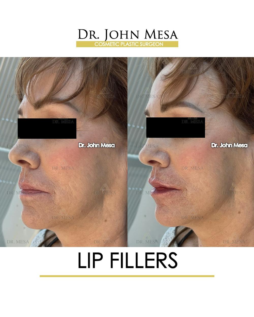 Lip Augmentation (Injectables) Before & After Gallery - Patient 309244 - Image 5