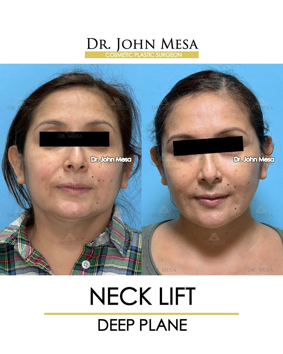 Neck Lift Before & After Gallery - Patient 531657 - Image 1