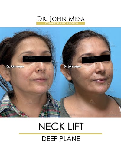 Neck Lift Before & After Gallery - Patient 531657 - Image 2