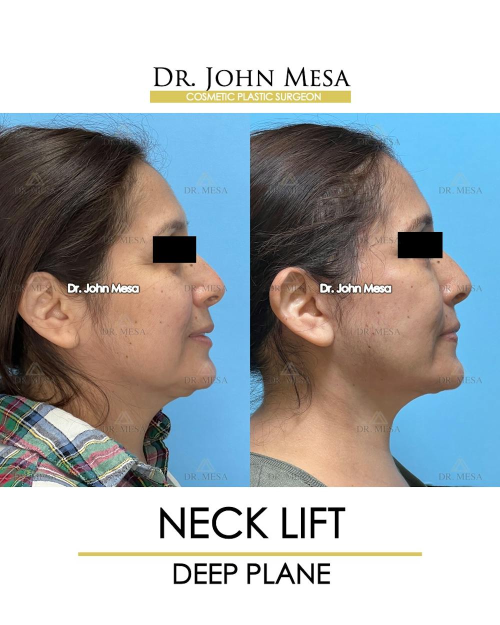 Neck Lift Before & After Gallery - Patient 531657 - Image 3