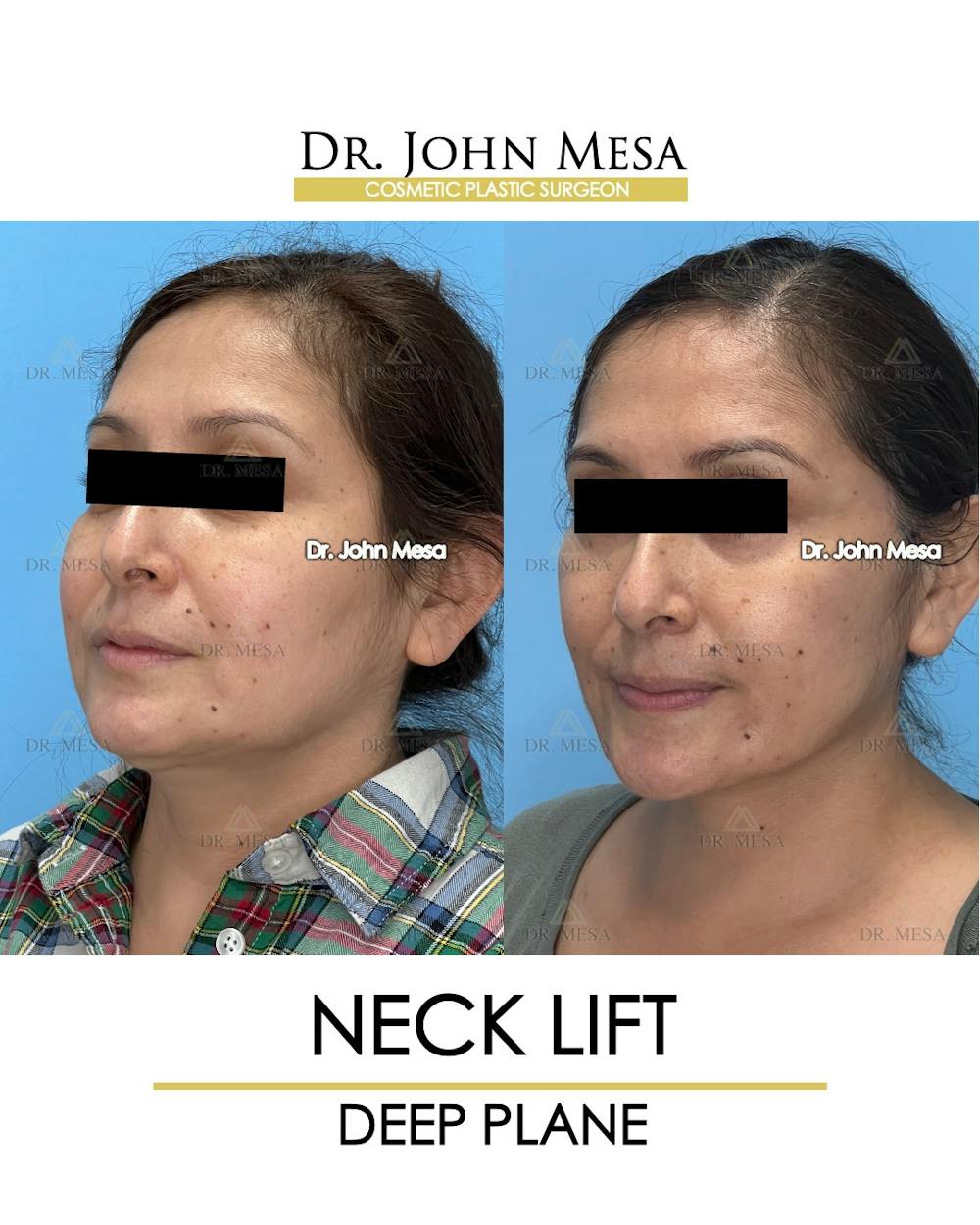 Neck Lift Before & After Gallery - Patient 531657 - Image 4