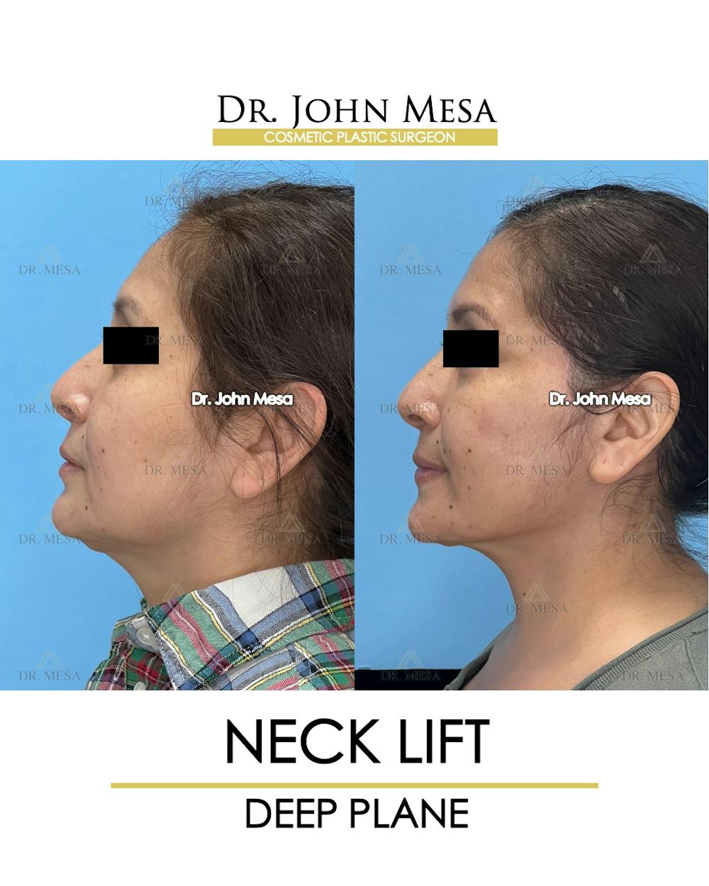 Neck Lift Before & After Gallery - Patient 531657 - Image 5