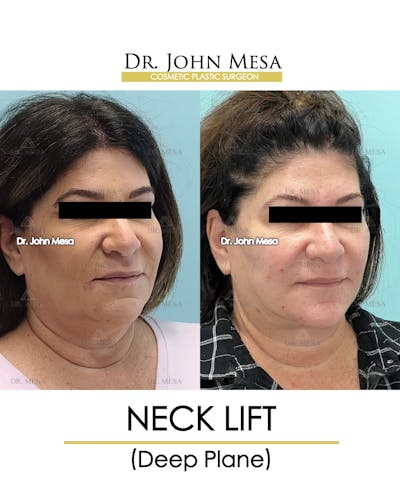 Neck Lift Before & After Gallery - Patient 243689 - Image 2