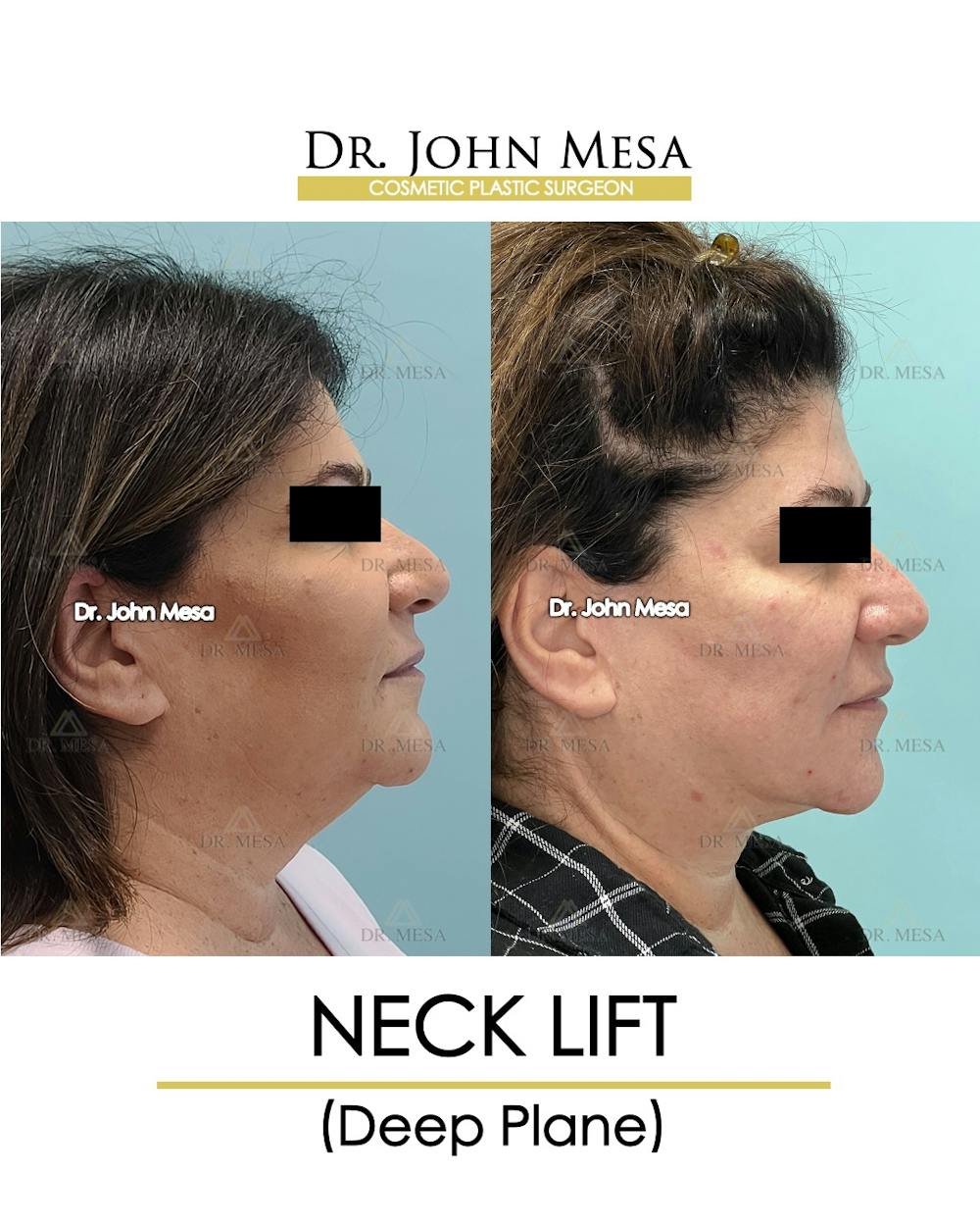 Neck Lift Before & After Gallery - Patient 243689 - Image 3