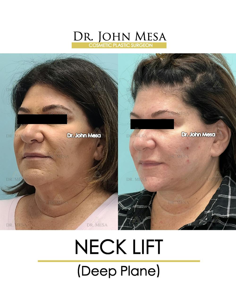 Neck Lift Before & After Gallery - Patient 243689 - Image 4