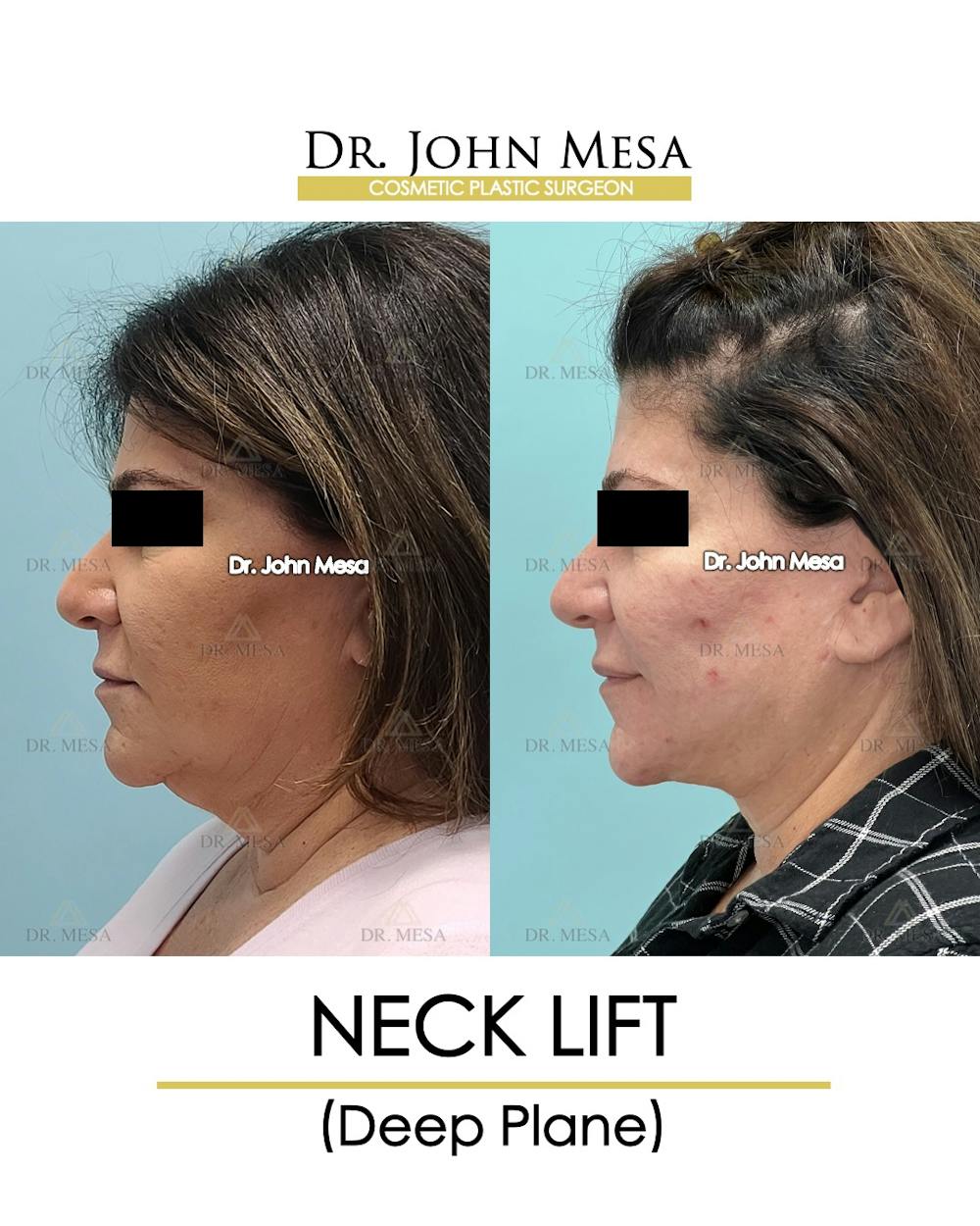 Neck Lift Before & After Gallery - Patient 243689 - Image 5