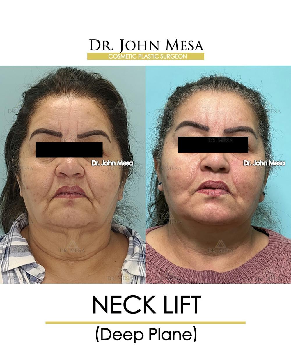 Neck Lift Before & After Gallery - Patient 360188 - Image 1