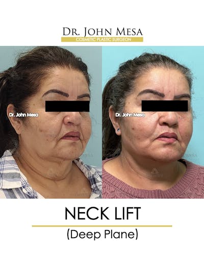 Neck Lift Before & After Gallery - Patient 360188 - Image 2