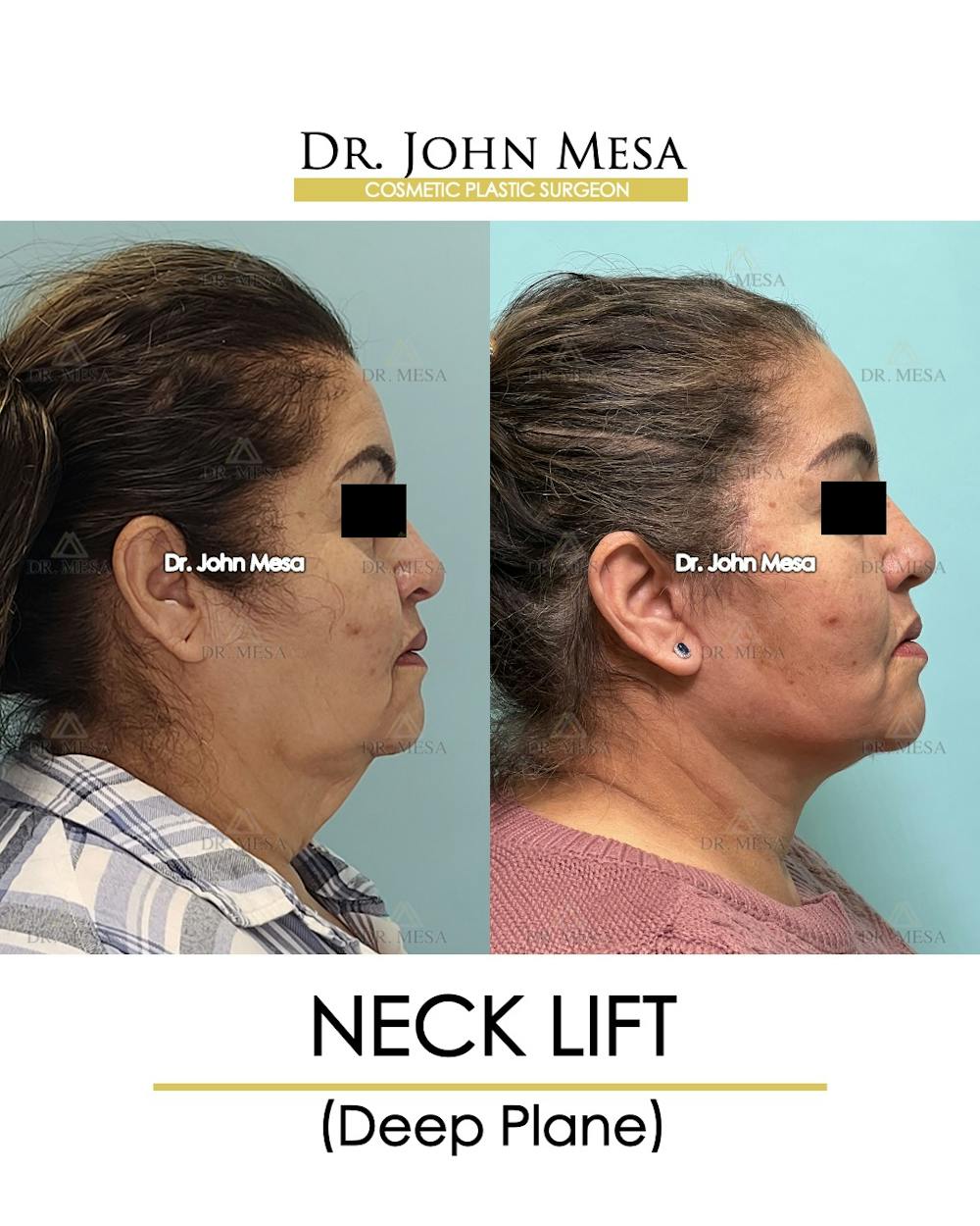 Neck Lift Before & After Gallery - Patient 360188 - Image 3