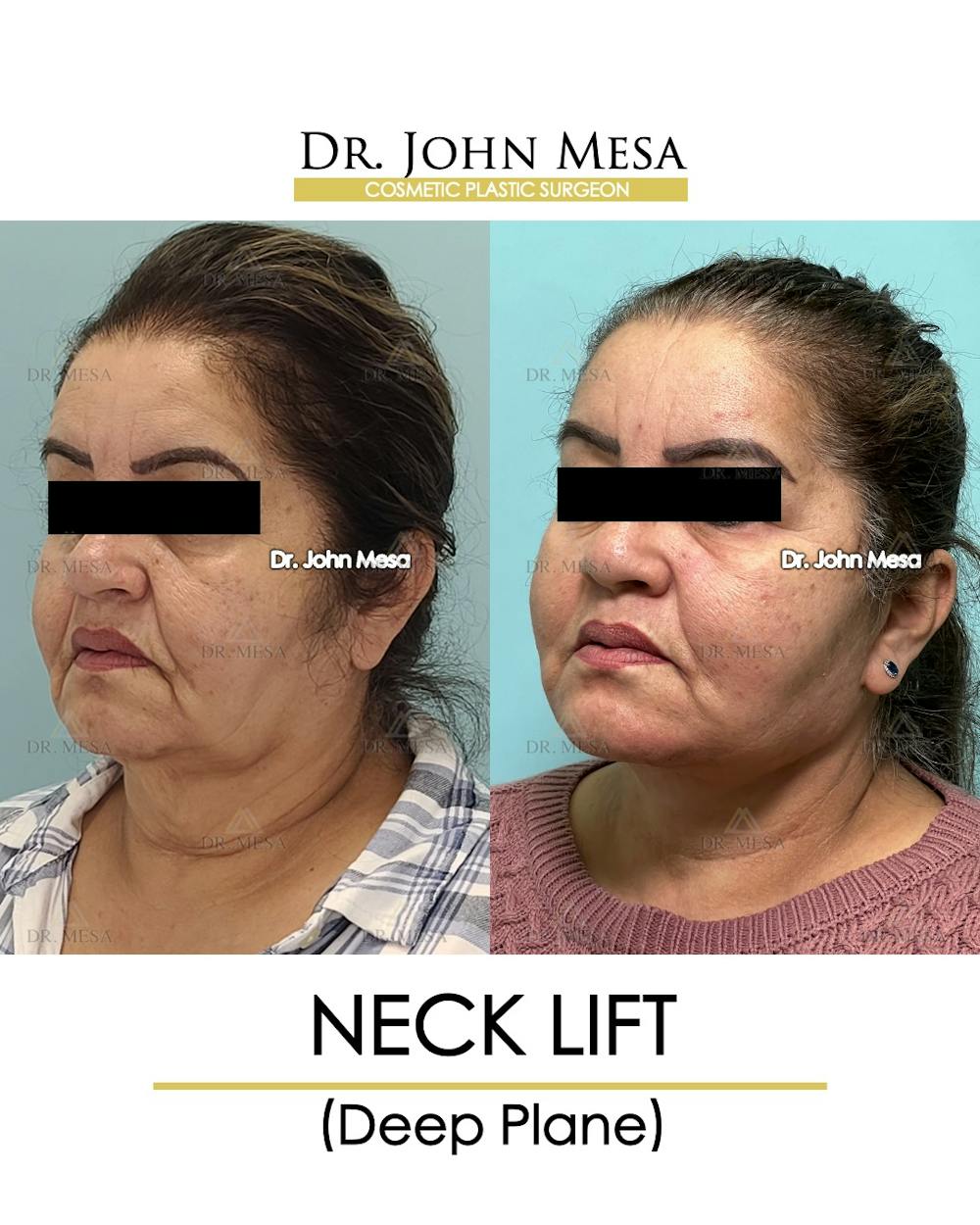 Neck Lift Before & After Gallery - Patient 360188 - Image 4