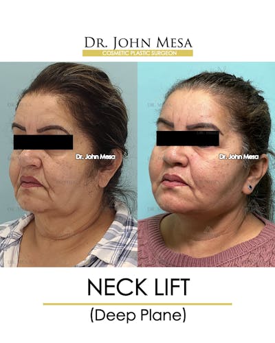 Neck Lift Before & After Gallery - Patient 360188 - Image 4