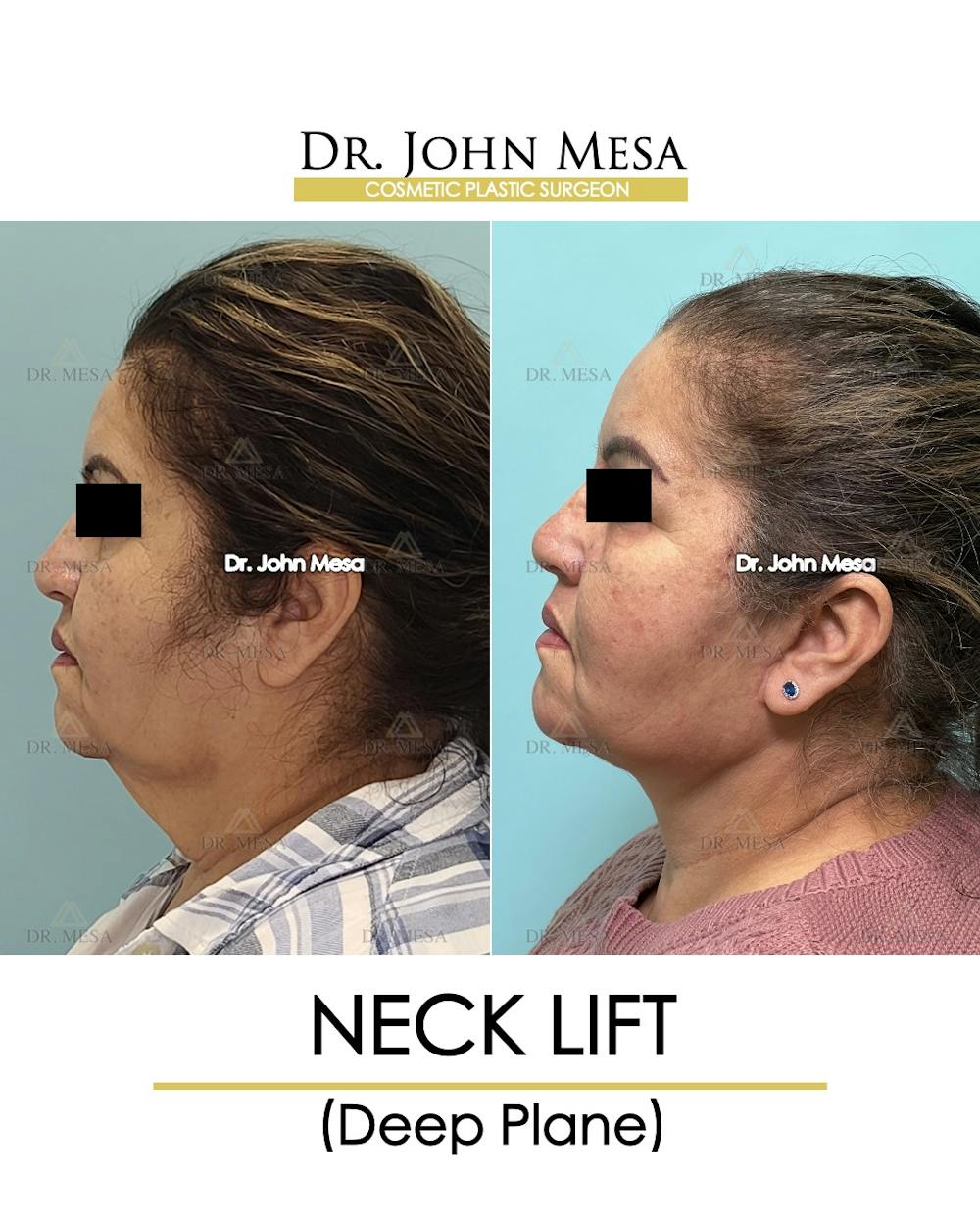 Neck Lift Before & After Gallery - Patient 360188 - Image 5