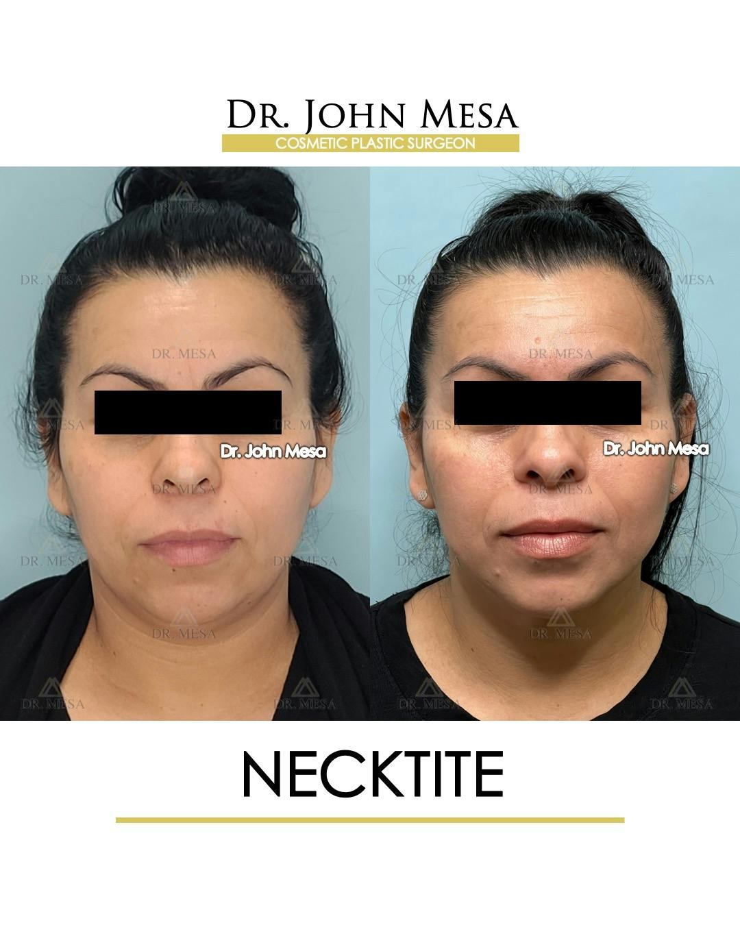 NeckTite Before & After Gallery - Patient 910788 - Image 1