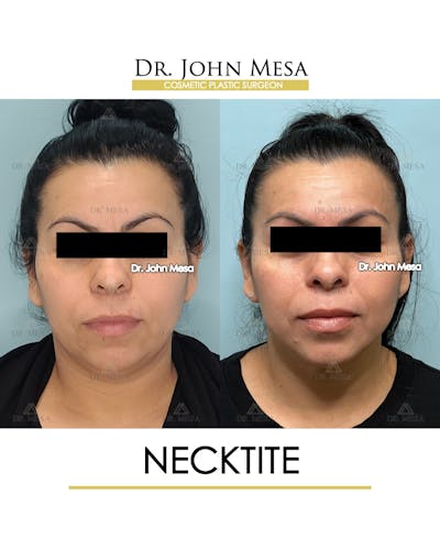NeckTite Before & After Gallery - Patient 910788 - Image 1