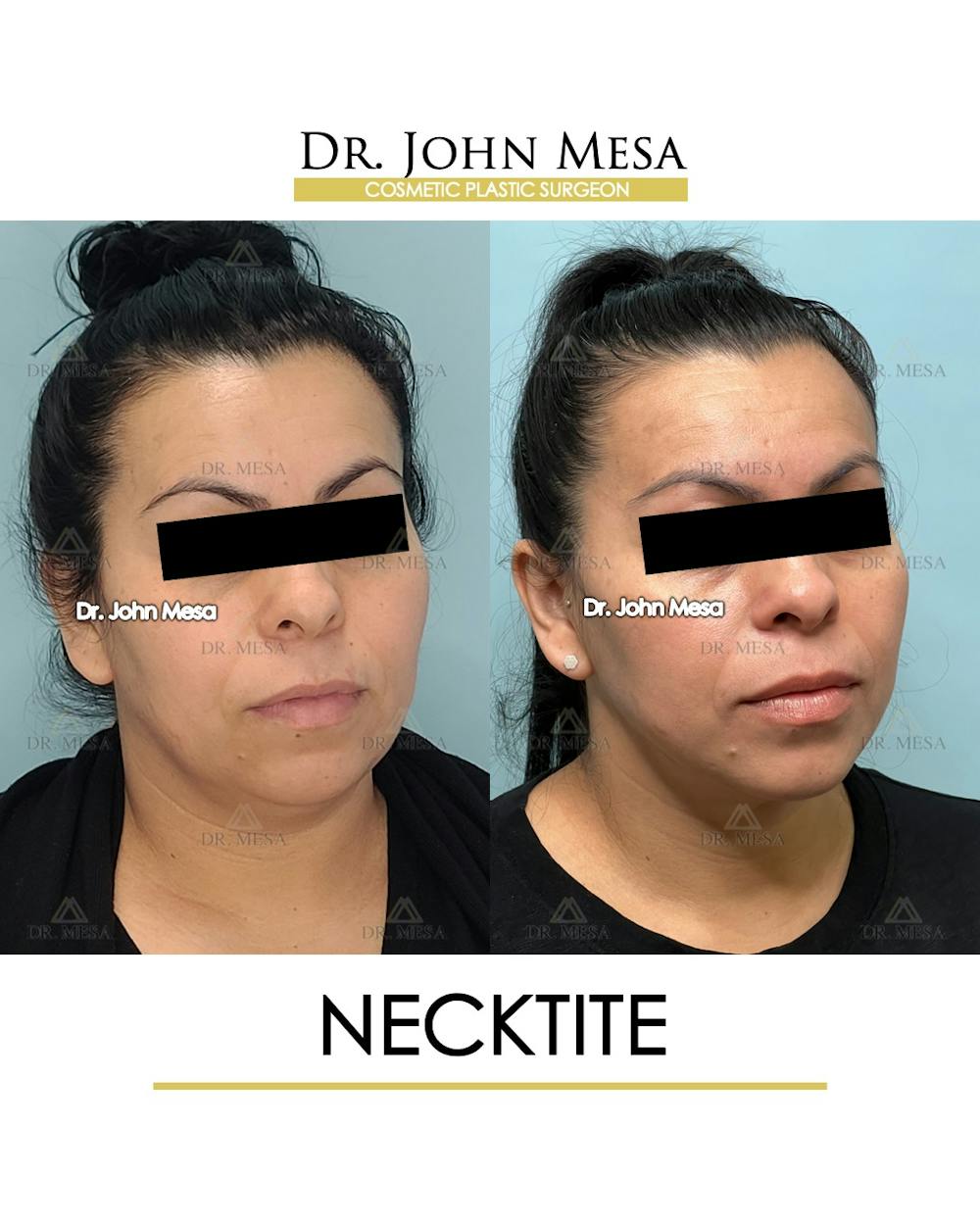 NeckTite Before & After Gallery - Patient 910788 - Image 2