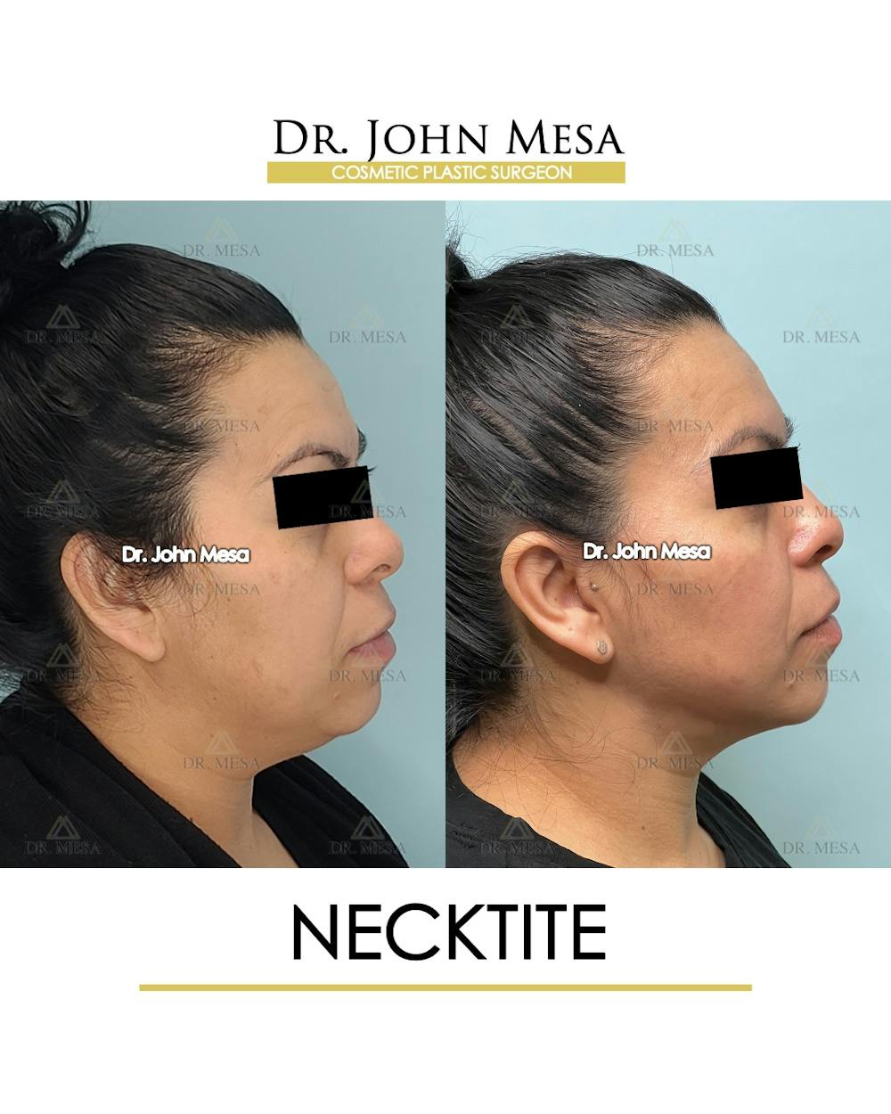 NeckTite Before & After Gallery - Patient 910788 - Image 3