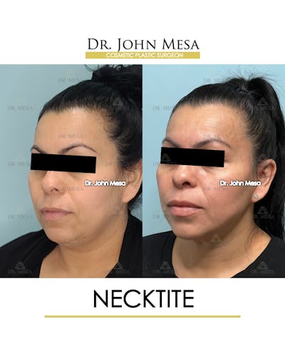 NeckTite Before & After Gallery - Patient 910788 - Image 4