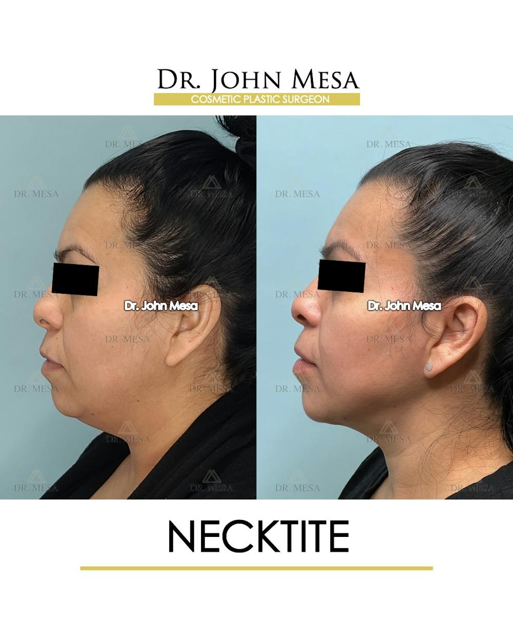 NeckTite Before & After Gallery - Patient 910788 - Image 5