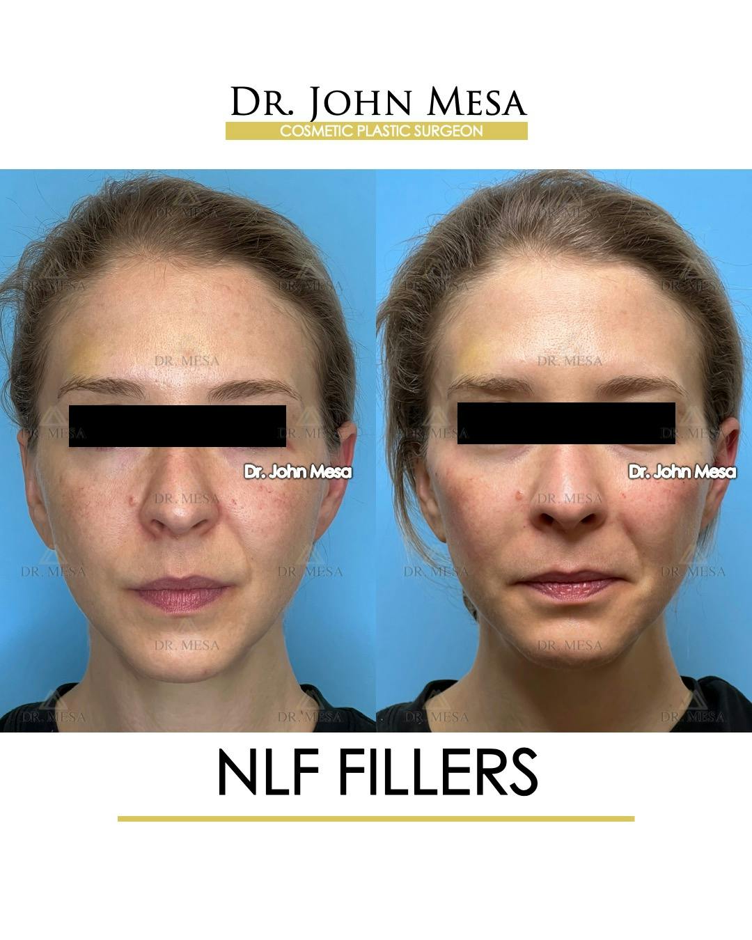 NLF Fillers Before & After Gallery - Patient 184231 - Image 1