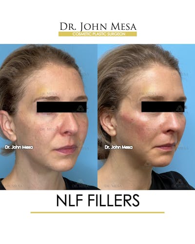 NLF Fillers Before & After Gallery - Patient 184231 - Image 2