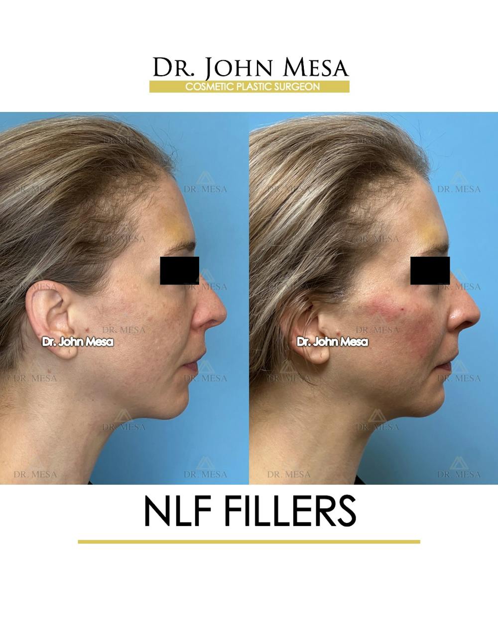 NLF Fillers Before & After Gallery - Patient 184231 - Image 3
