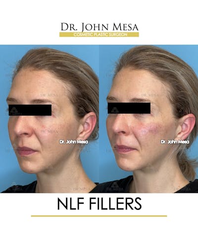 NLF Fillers Before & After Gallery - Patient 184231 - Image 4