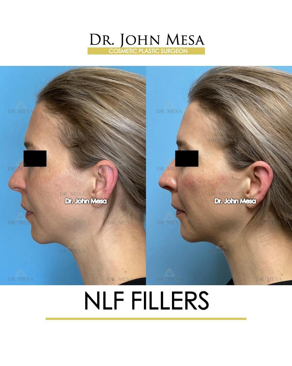 NLF Fillers Before & After Gallery - Patient 184231 - Image 5